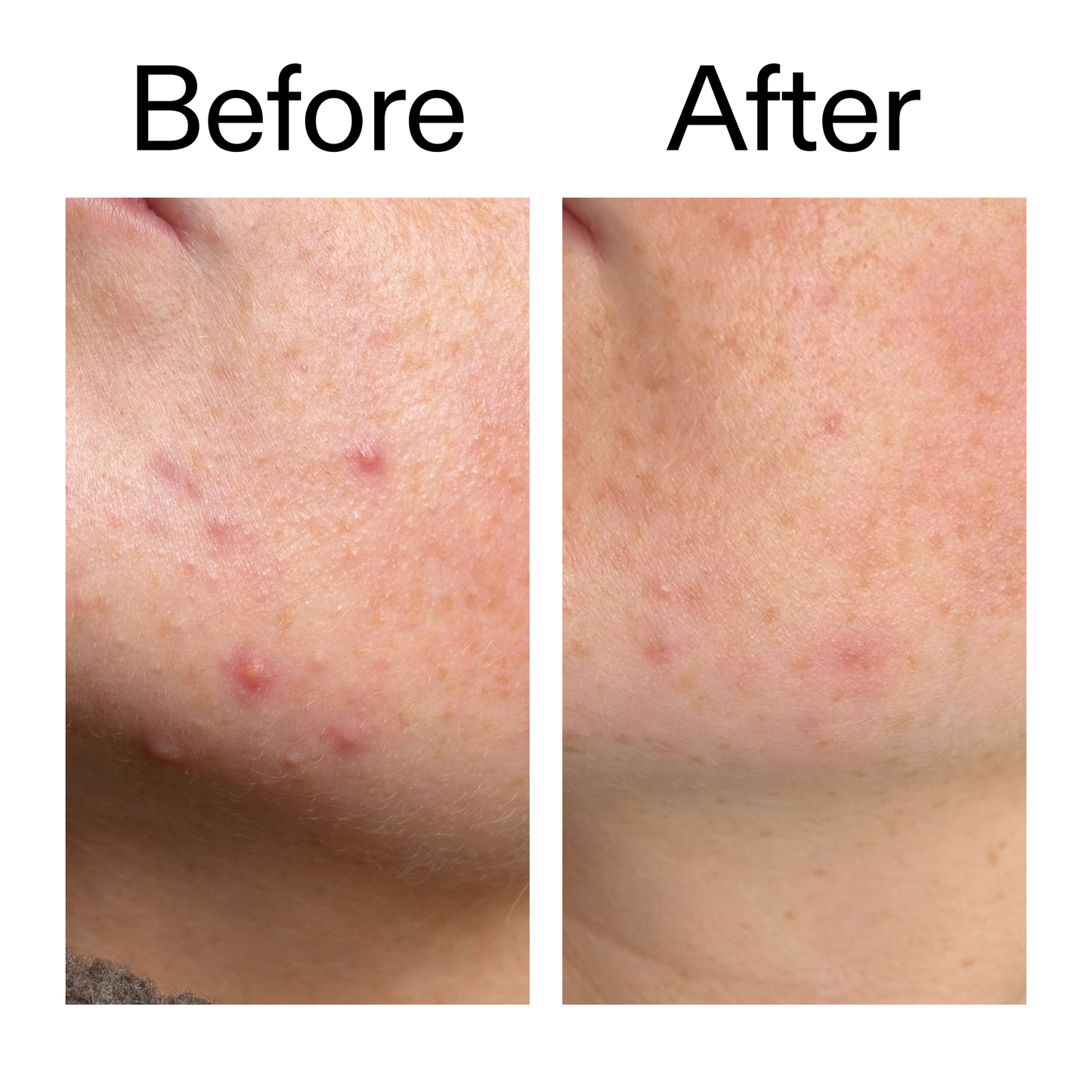 10-azelaic-acid-serum-for-redness-relief-w4 B_A_1_PPAGE.png