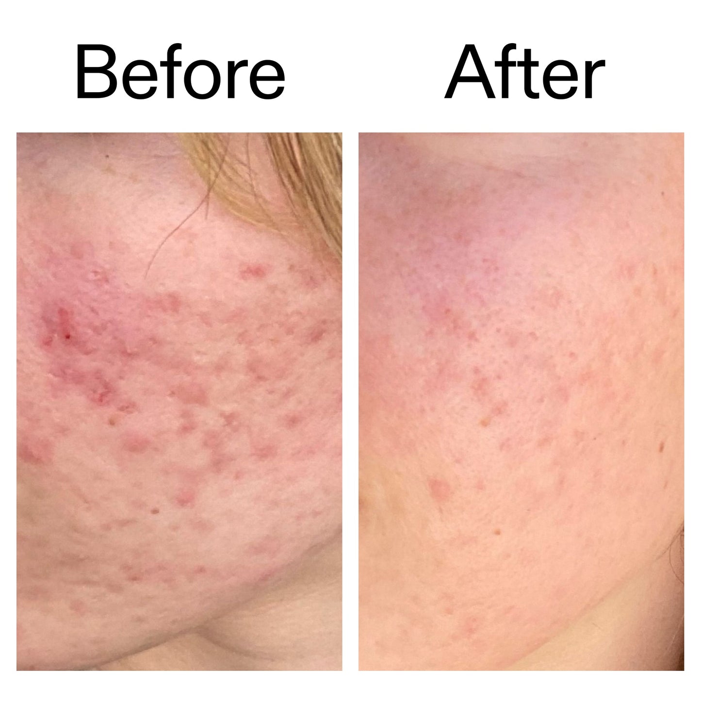 10-azelaic-acid-serum-for-redness-relief-w4 Azealic_Acid_Serum_B_A_Ppage_2000_x_2000.jpg