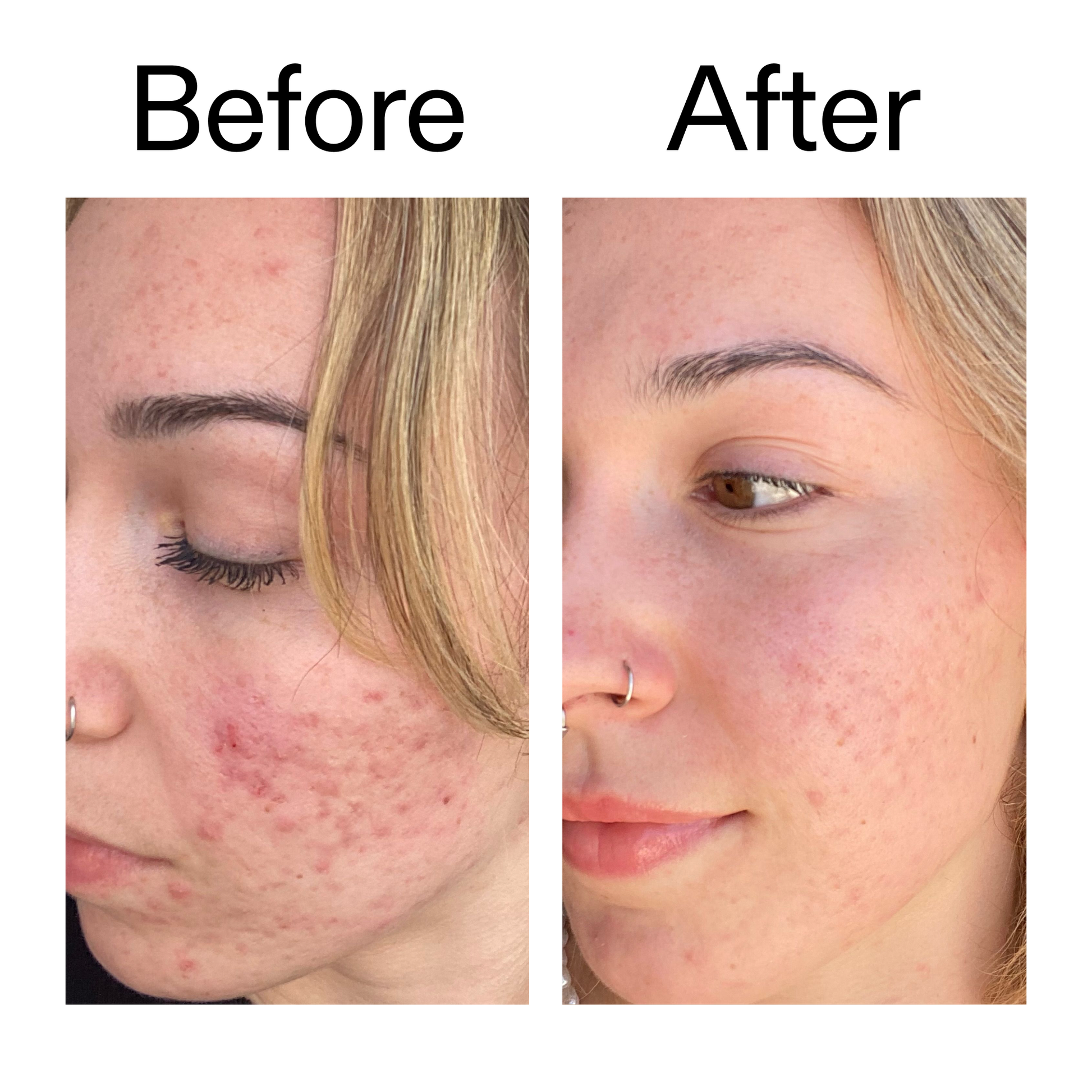 10-azelaic-acid-serum-for-redness-relief-w4 B_A_2_PPAGE.png