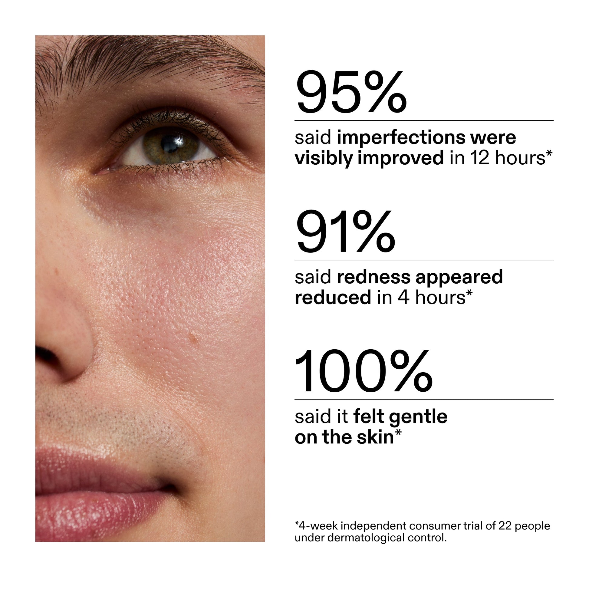 succinic-acid-acne-treatment-o2 CA_Succinic_Acid_Treatment_key_Claims_2000x2000_db91b0f1-7f29-4bfe-bb16-63a47f500960.jpg