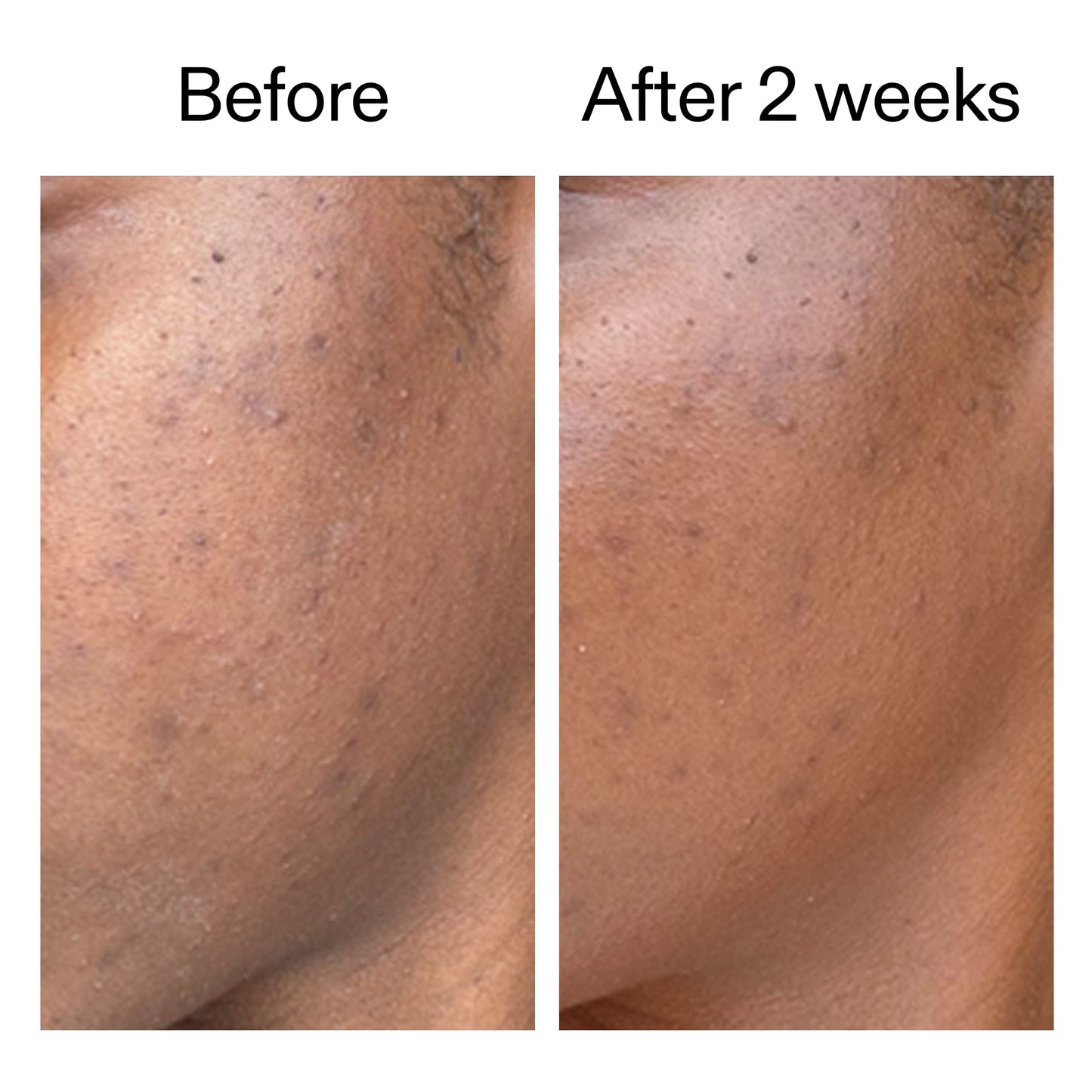360-acne-clearing-serum-v2 DIOICB_A2000x2000.jpg