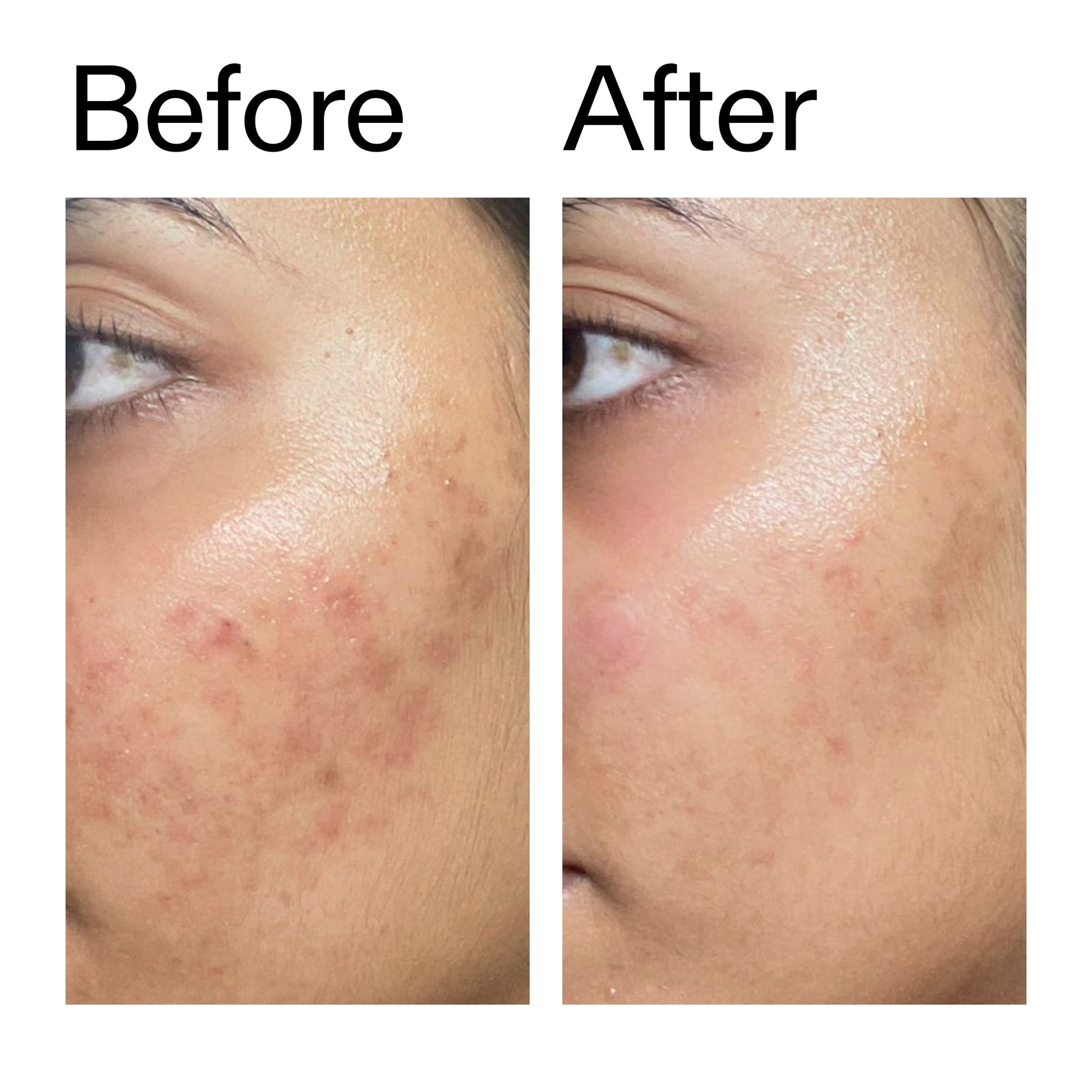 ectoin-hydro-barrier-serum-z1 Ectoin_Hydro-barrier_Serum__Before_After_2000x2000_34261920-d004-48d0-9c7b-8e1c15971bfd.jpg