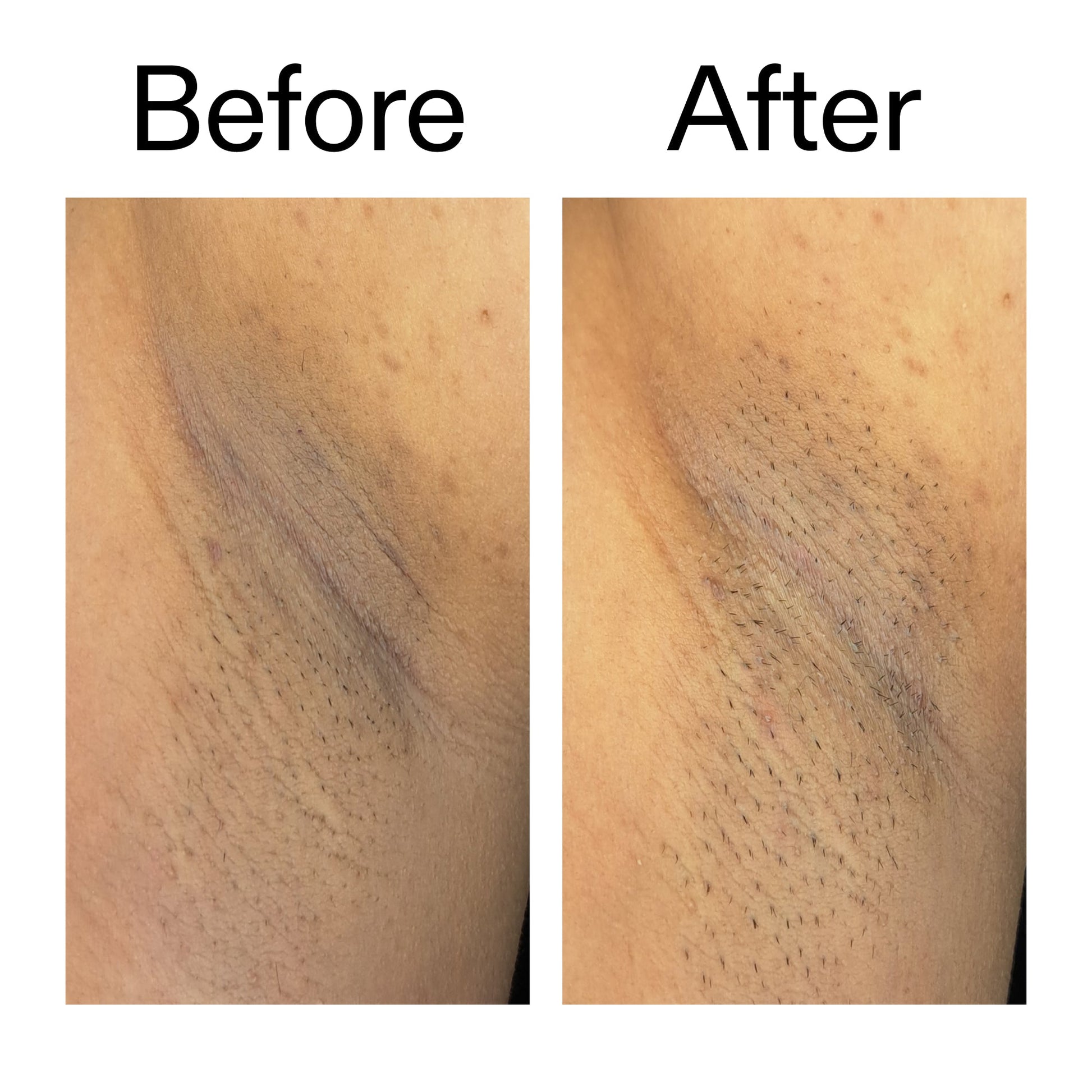 glycolic-acid-exfoliating-body-stick-p8 Glycolic_Acid_Exfoliating_Body_Stick_Before_After_V3_2000x2000_ea919cd9-1439-4a46-82a0-76200eb5bb42.jpg