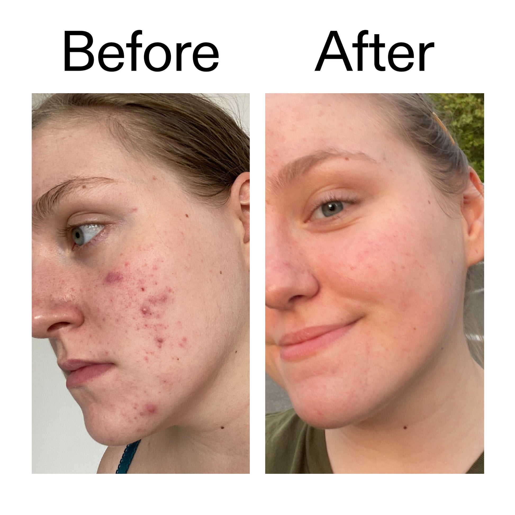 glycolic-acid-toner-t8 Glycolic_Acid_Toner_Before_After_2000x2000_49f0b9f7-e71b-4b2e-a8f8-2ea4b73247bb.jpg