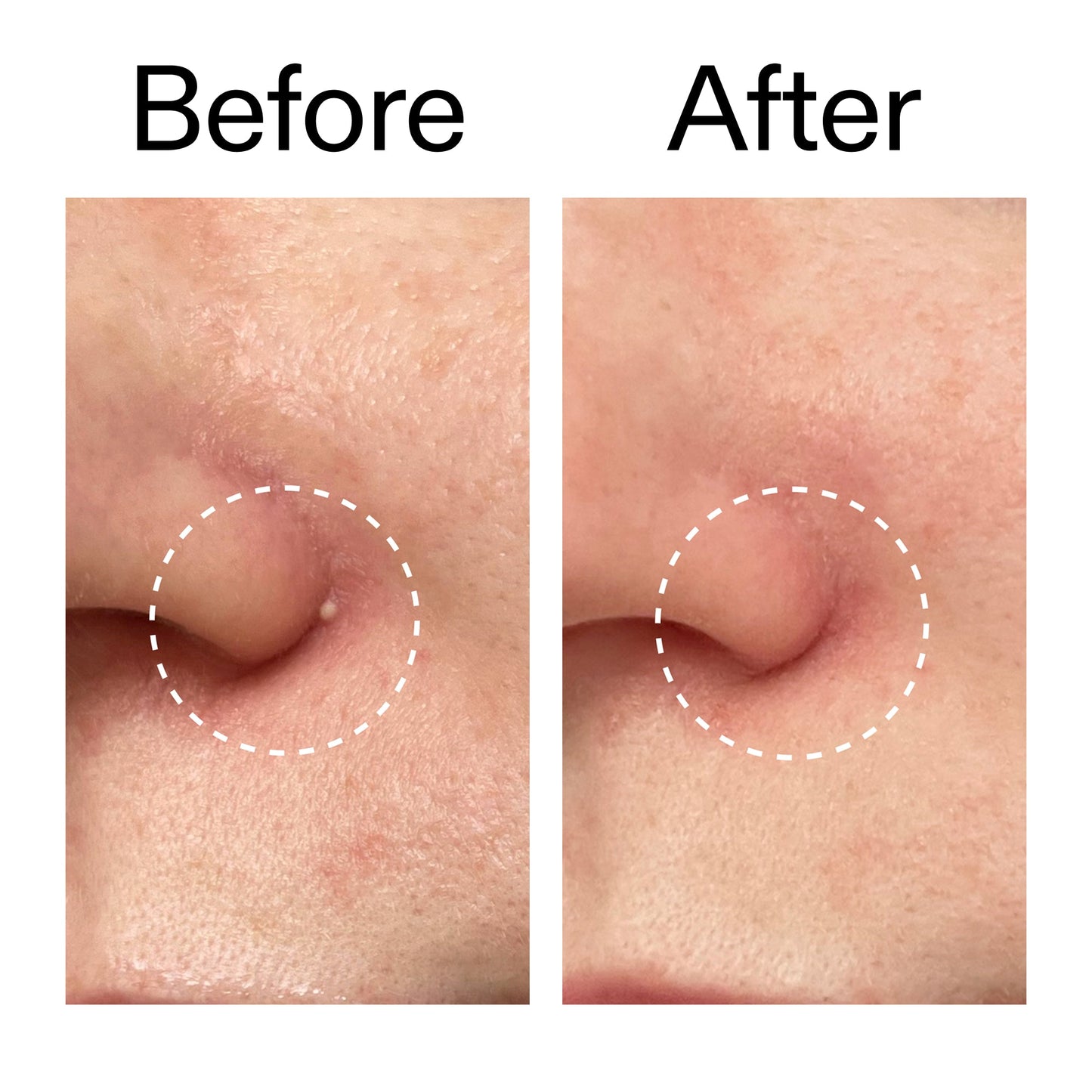 hydrocolloid-invisible-pimple-patches-pack-of-22-o2 Hydrocolloid_Invisible_Pimple_Patches_Before_After_2000x2000_b02aa37b-c78a-4682-91de-9135af5bb7df.jpg