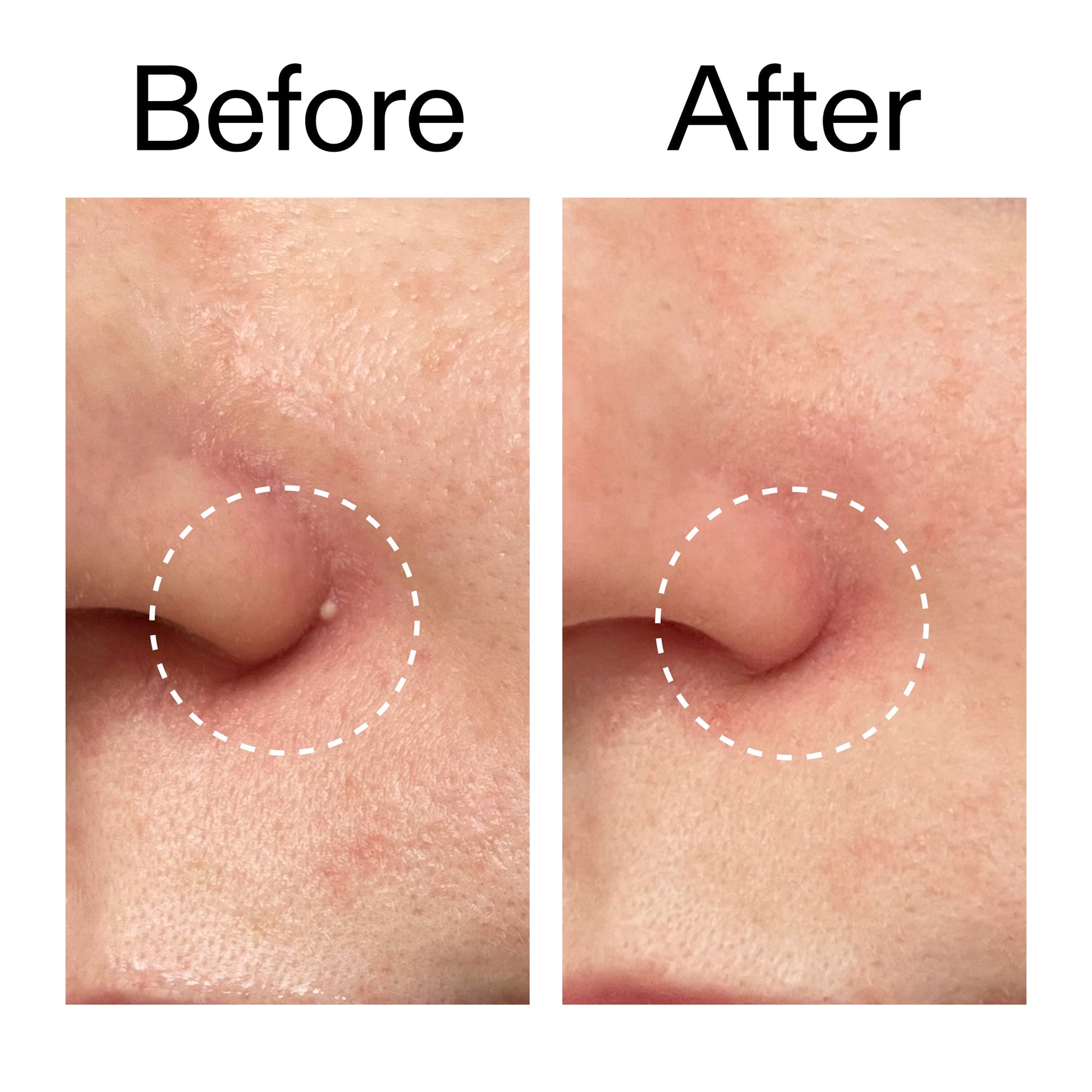 hydrocolloid-invisible-pimple-patches-pack-of-22-o2 Hydrocolloid_Invisible_Pimple_Patches_Before_After_2000x2000_b02aa37b-c78a-4682-91de-9135af5bb7df.jpg