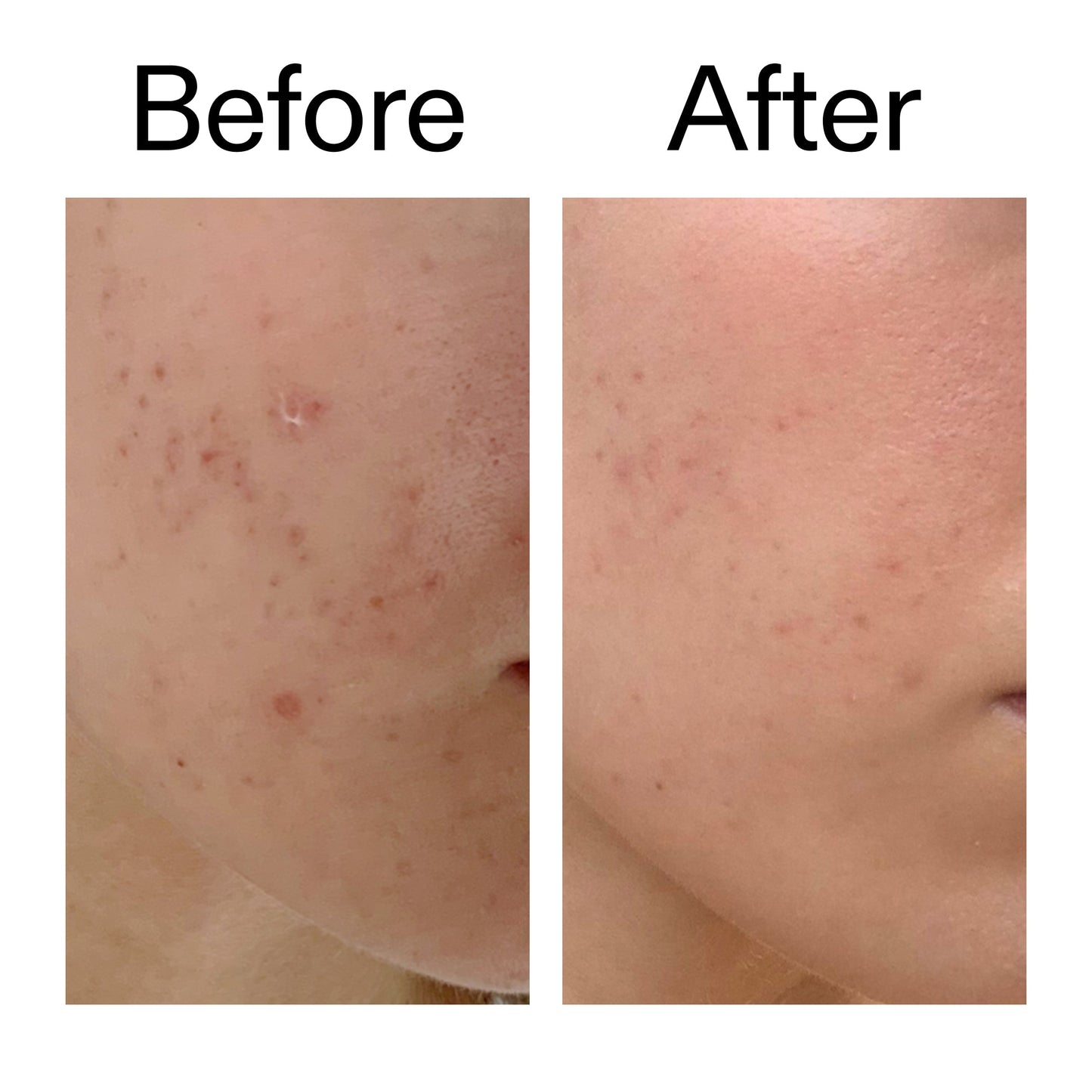 mandelic-acid-treatment-r2 Mandelic_Acid_Treatment_Before_After_2000x2000_4885ac6e-c5d7-4279-a72a-1417af7dce35.jpg