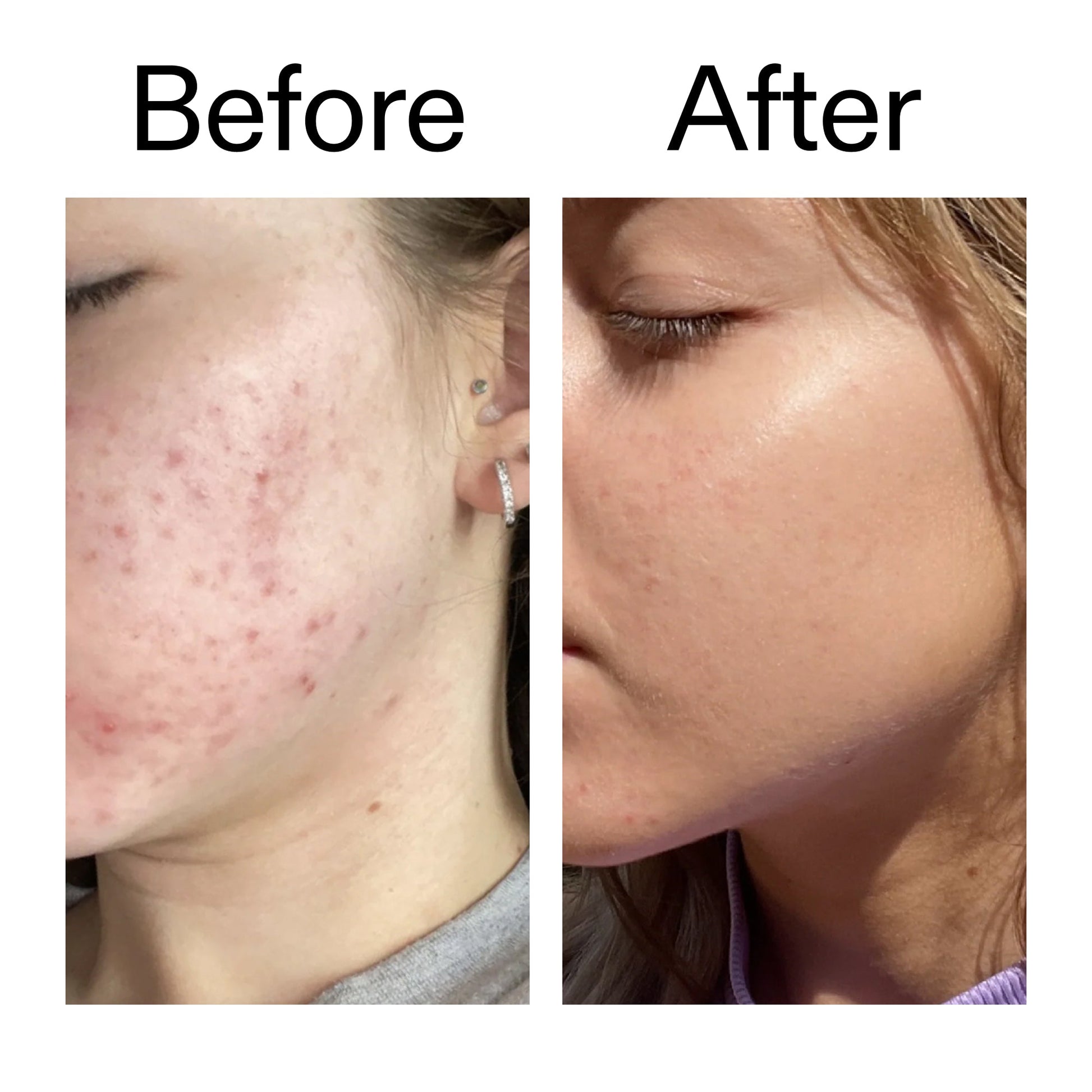 10-niacinamide-serum-duo-b9 Niacinamide_Serum_Before_After_2000x2000_bde32455-9e7d-448e-b053-bef41504f0a9.jpg