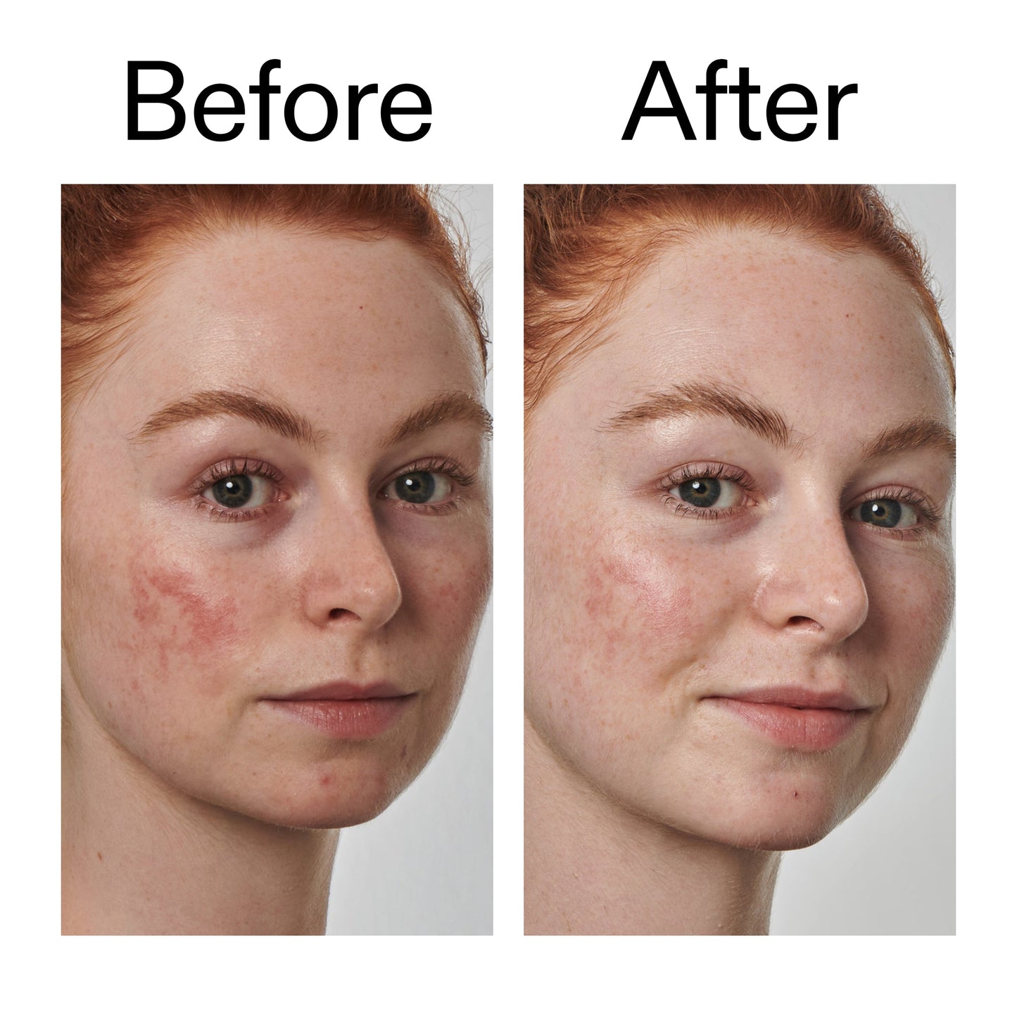 10-azelaic-acid-serum-for-redness-relief-w4 Redness_Relief_Serum_Before_After_2000x2000_3334dc9a-cce9-4e00-8aec-7ad89ca051f2.jpg