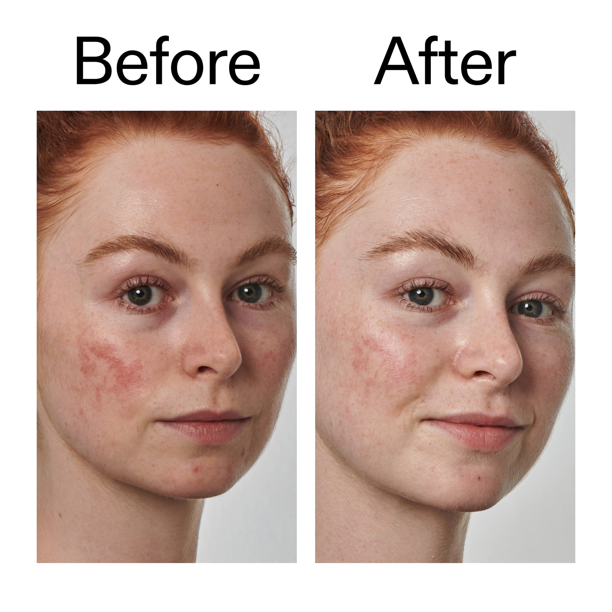 10-azelaic-acid-serum-for-redness-relief-w4 Redness_Relief_Serum_Before_After_2000x2000_3334dc9a-cce9-4e00-8aec-7ad89ca051f2.jpg