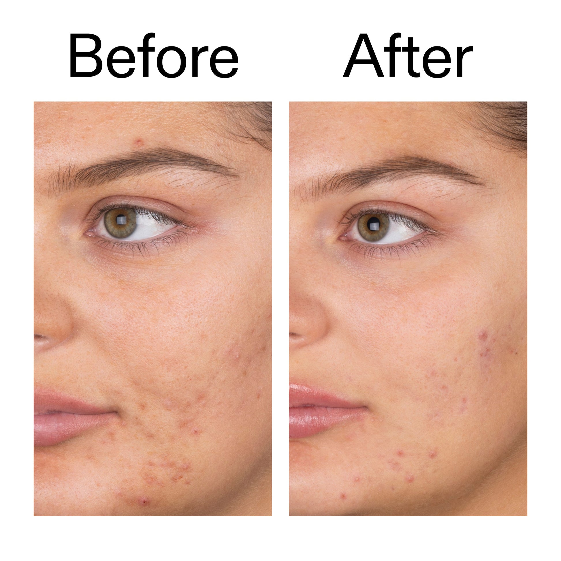 salicylic-acid-cleanser-150ml-m1 Salicylic_Acid_Cleanser_-_150ml_Before_After_2000x2000_e7230494-853f-4b07-82b1-27669104c995.jpg