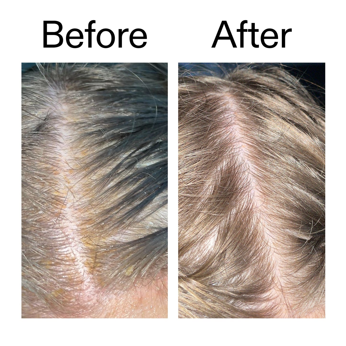 salicylic-acid-exfoliating-scalp-treatment-y8 Salicylic_Acid_Exfoliating_Scalp_Treatment_Before_After_2000x2000_e572a30f-057c-4a48-823b-1c09dc97f8d0.jpg