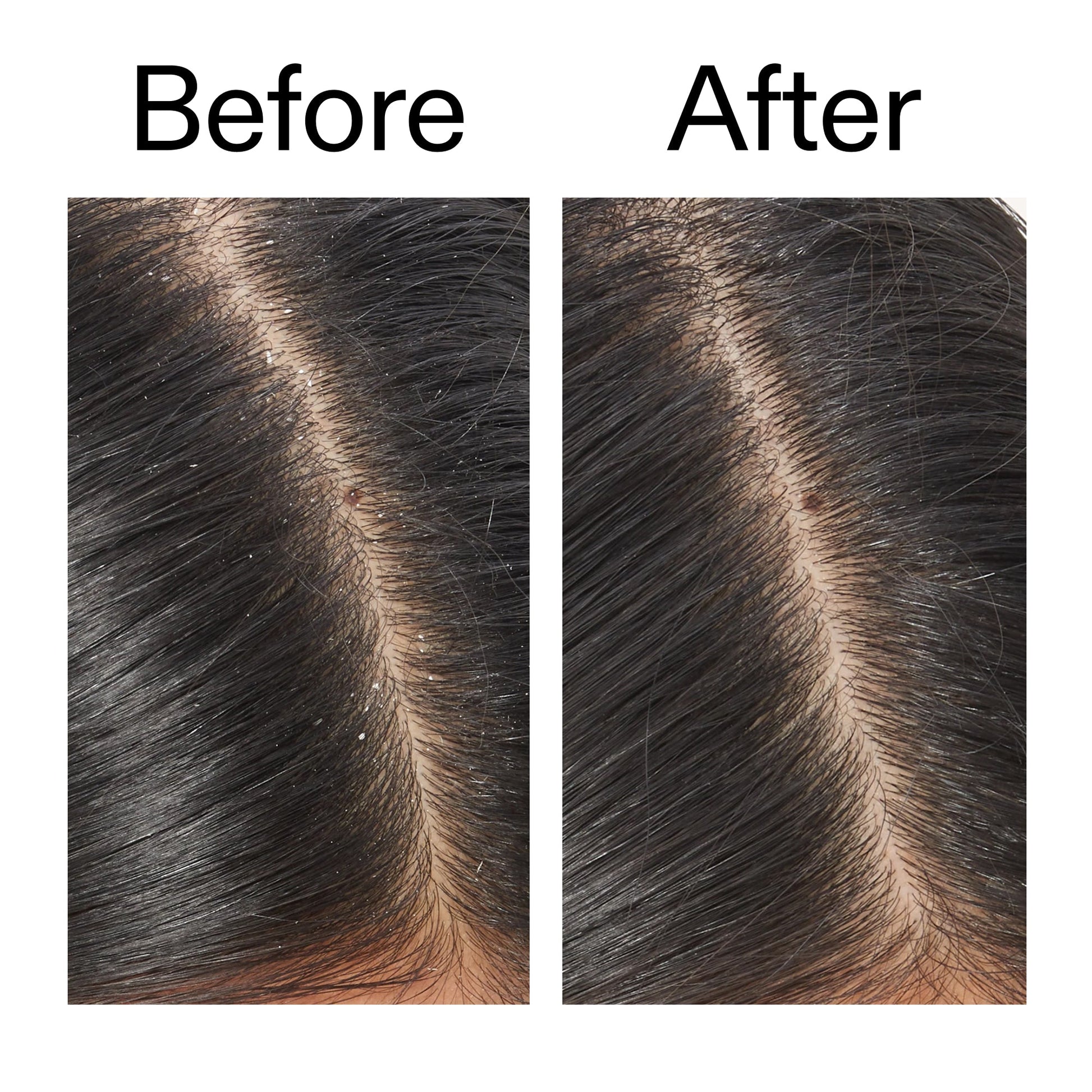 salicylic-acid-exfoliating-scalp-treatment-k4 Salicylic_Acid_Exfoliating_Scalp_Treatment_Before_After_V2_2000x2000_02bd61ad-42bf-490b-b3e3-7e04b2e8a673.jpg
