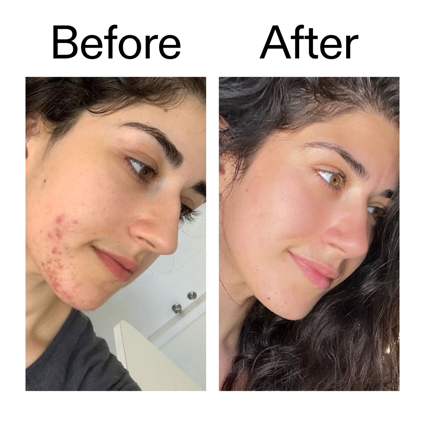 succinic-acid-acne-treatment-o2 Succinic_Acid_Treatment_Before_After_2000x2000_6a5f0054-2f58-4433-9314-0dc72c9bdd3b.jpg