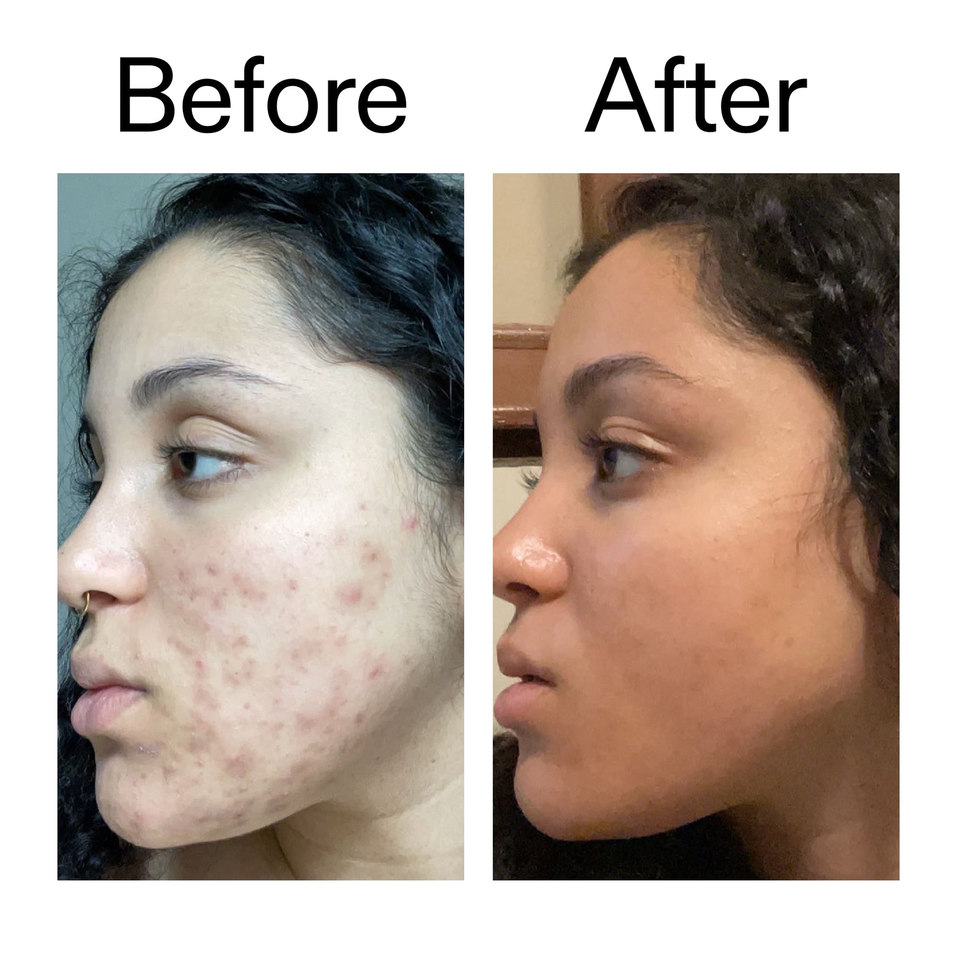 tranexamic-acid-serum-a4 Tranexamic_Acid_Serum_Before_After_2000x2000_98ebc8be-77b0-4843-8a22-90790ebe918b.jpg